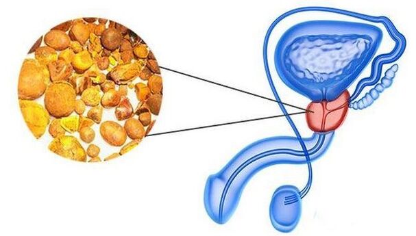 Kalcina prostatas dziedzerī