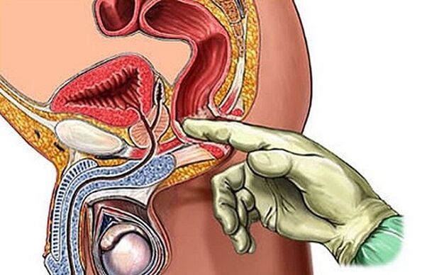 Prostatas masāža kā prostatīta ārstēšanas veids