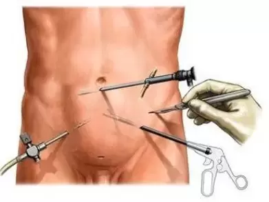 Hroniska prostatīta ķirurģiska ārstēšana