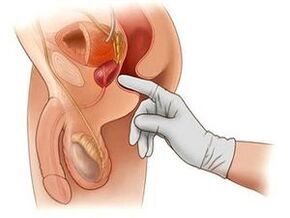 prostatas masāža prostatīta ārstēšanai