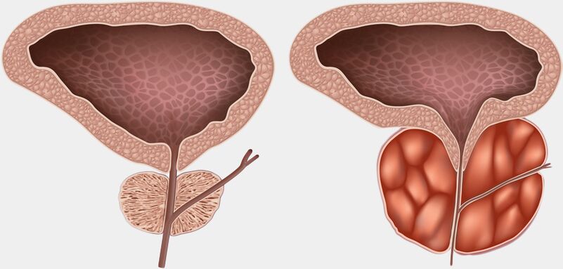 vesela un iekaisusi prostata ar prostatītu