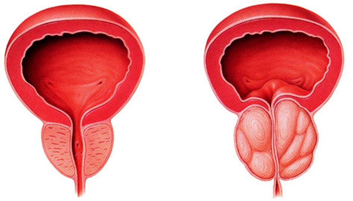 vesela un iekaisusi prostata ar prostatītu