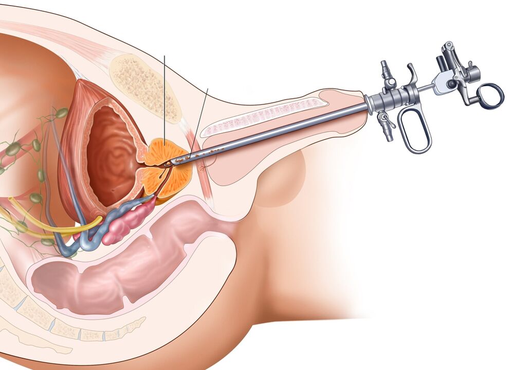 Prostatas transuretrāla rezekcija ļauj noņemt skartās orgāna daļas