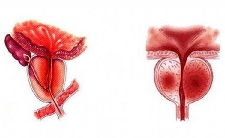 Akūts prostatas dziedzera iekaisums, kas var kļūt hronisks